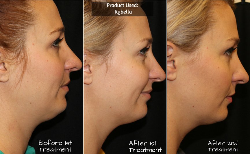 Kybella Treatment Chandler AZ | Before & After Photos Neck Lift