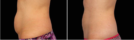 CoolSculpting ELITE Fat Reduction near Gilbert, Mesa, Chandler