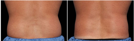Before and After Treatment Photos: back view, 8 Weeks After CoolSculpting Session, Photos Courtesy of Leyda E. Bowes, MD