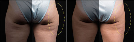 CoolSculpting: Reshape Your Body without Surgery - Bachelor, Eric  ()