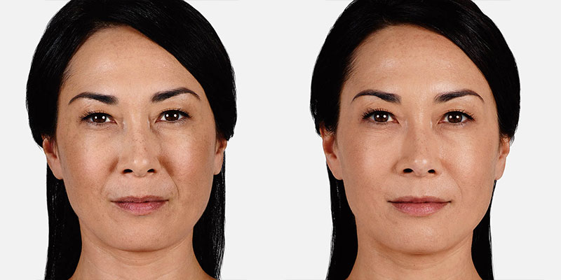 Restylane Restylane Filler Treatment Phoenix Az 