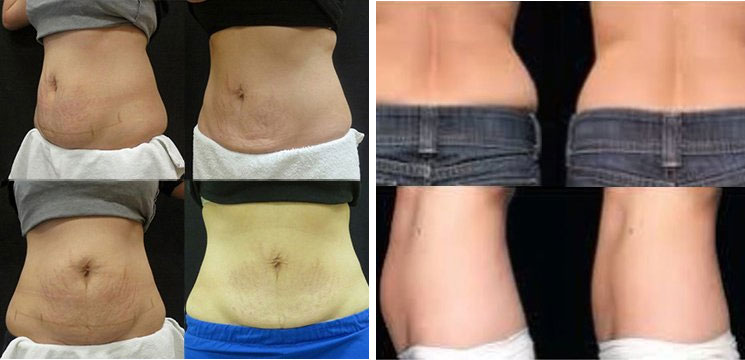 Tummy Tuck in Chandler AZ