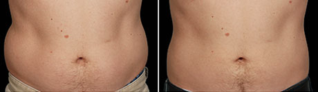 CoolSculpting: Reshape Your Body without Surgery - Bachelor, Eric