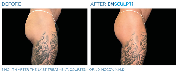 Before and After EmSculpt Neo Treatment