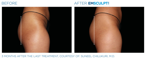 Before and After EmSculpt Treatment