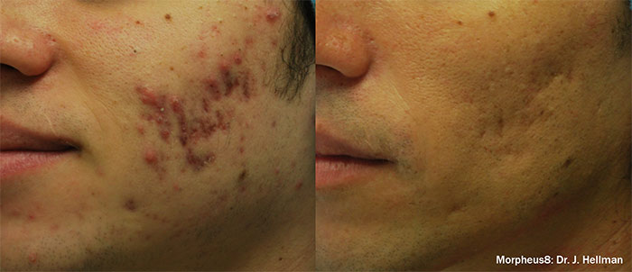 Male face, before and after Morpheus8 treatment, oblique view, patient 4