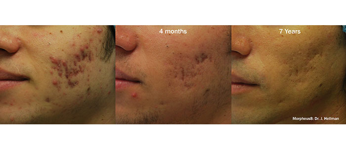 Male face, before and 4 mounths/7 Years after Morpheus8 treatment, oblique view, patient 5