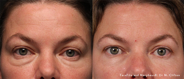 Woman's face, before and after Morpheus8 treatment, front view, patient 1