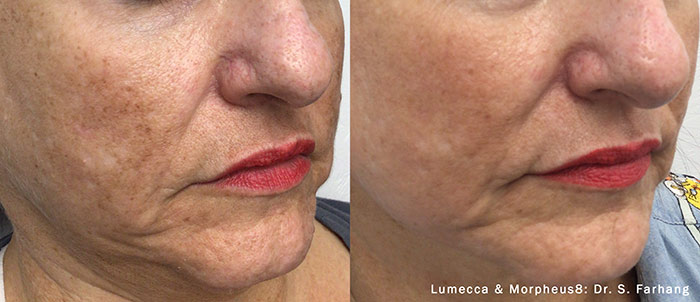 Woman's face, before and after Morpheus8 treatment, oblique view, patient 2