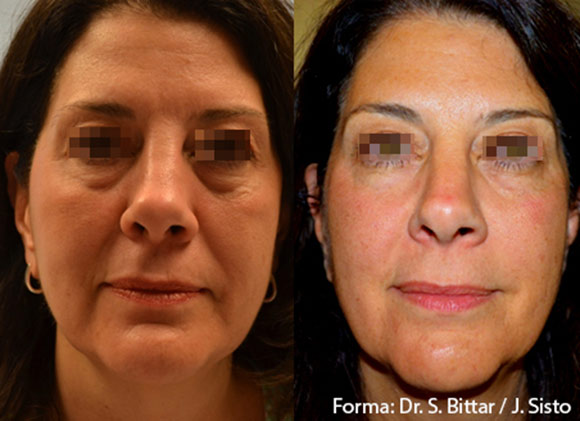 Female face, before and after Skin Tightening with FormaV treatment, front view, patient 1