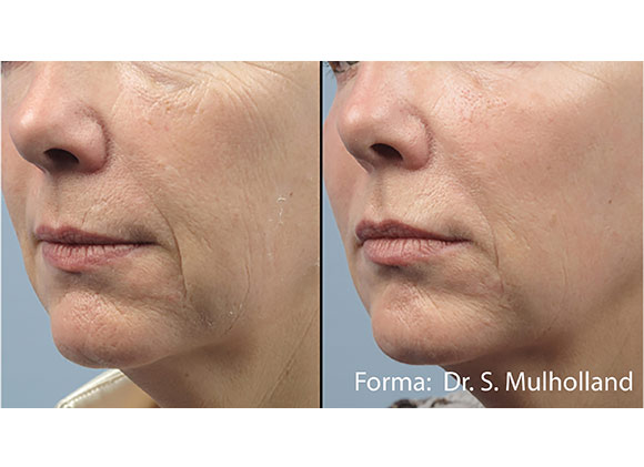 Female face, before and after Skin Tightening with FormaV treatment, oblique view, patient 2