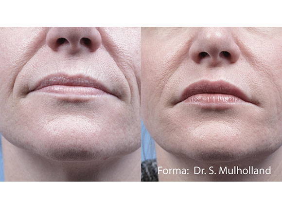 Female face, before and after Skin Tightening with FormaV treatment, front view, patient 3