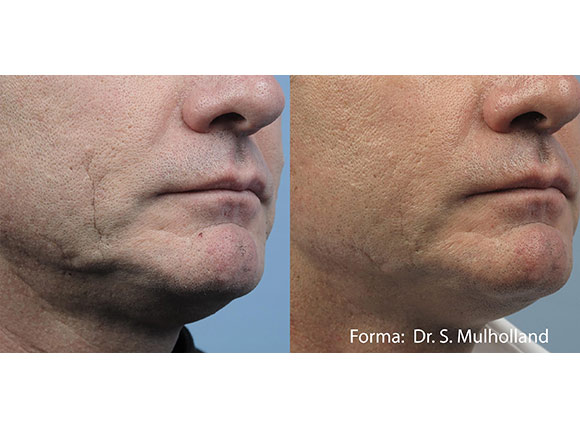 Male face, before and after Skin Tightening with FormaV treatment, front view, patient 4